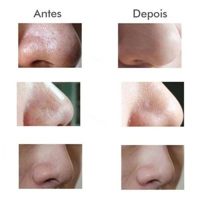 Máquina Sucção A Vácuo Remove Cravos Aparelho Acne Cleaning