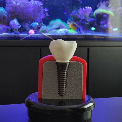 Implante Dental Análise Modelo Dentário Dente 3D Anatomia