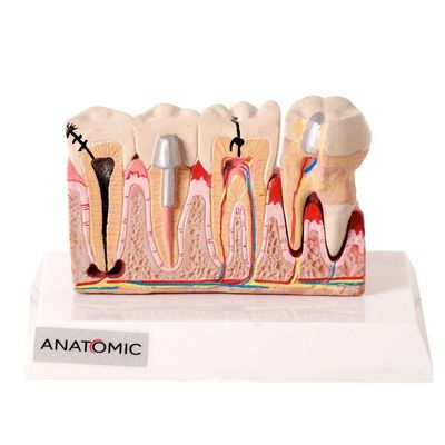 Patologia Dentária e Placa Explicativa em 2 Partes Modelo