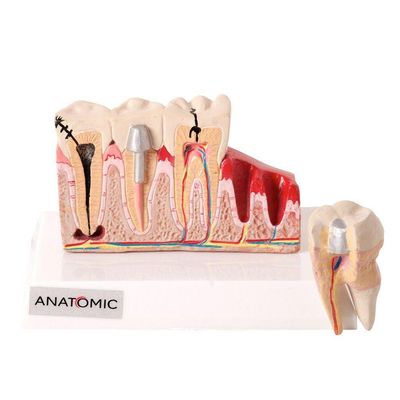 Patologia Dentária e Placa Explicativa em 2 Partes Modelo