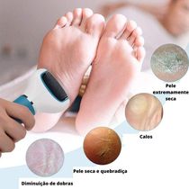 Lixa P/ Pé Elétrico Removedor Calos Recarregavel Lixadeira Usb Arrendondada