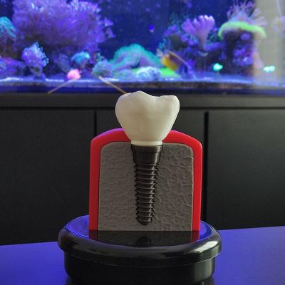 Implante Dental Análise Modelo Dentário Dente 3d Anatomia