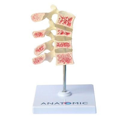 Vértebras Com Osteoporose 4 Vértebras