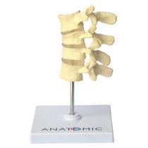 Vértebras Com Osteoporose 4 Vértebras