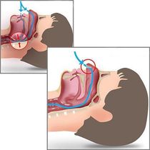 Dilatador Nasal Anti Ronco E Apnéia Do Sono Clip Nasal