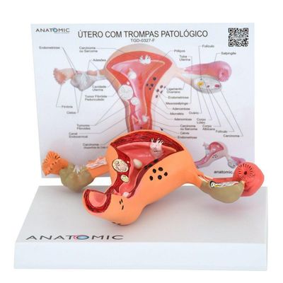 Útero Comtrompas Patológico Em Prancha, Anatomia
